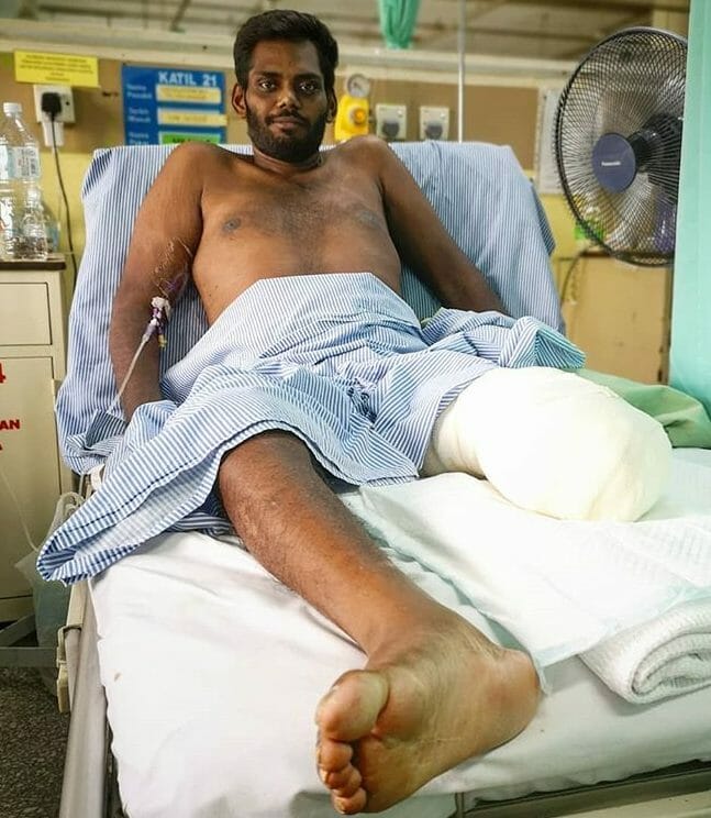 Me On My Hospital Bed With My Amputated Leg.