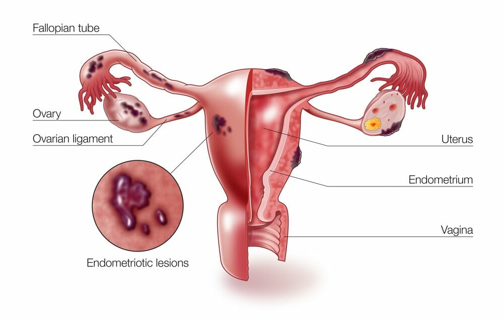 Diagram of endometriosis lesions on the uterus