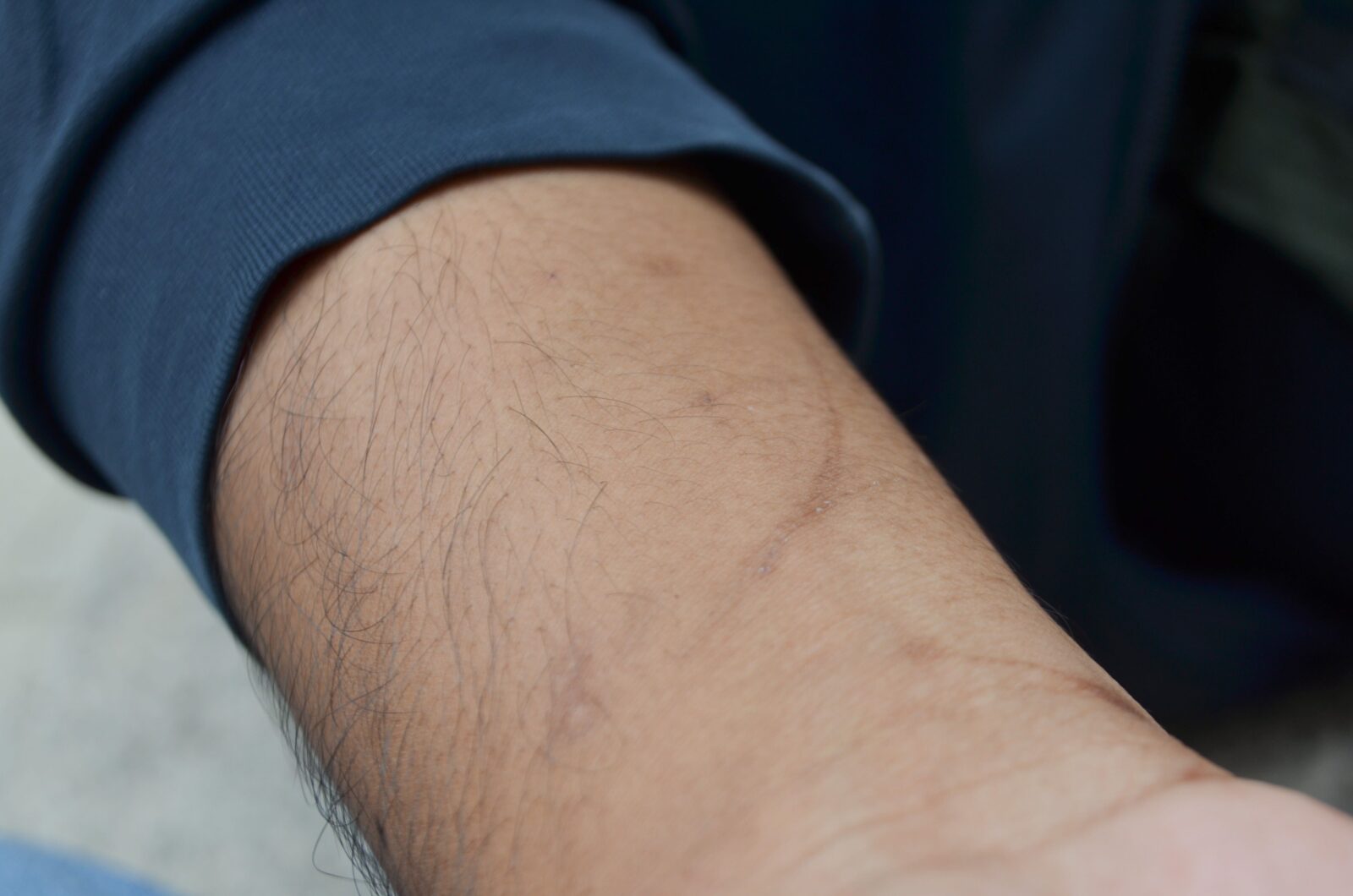 dog bite scars on a man's hand