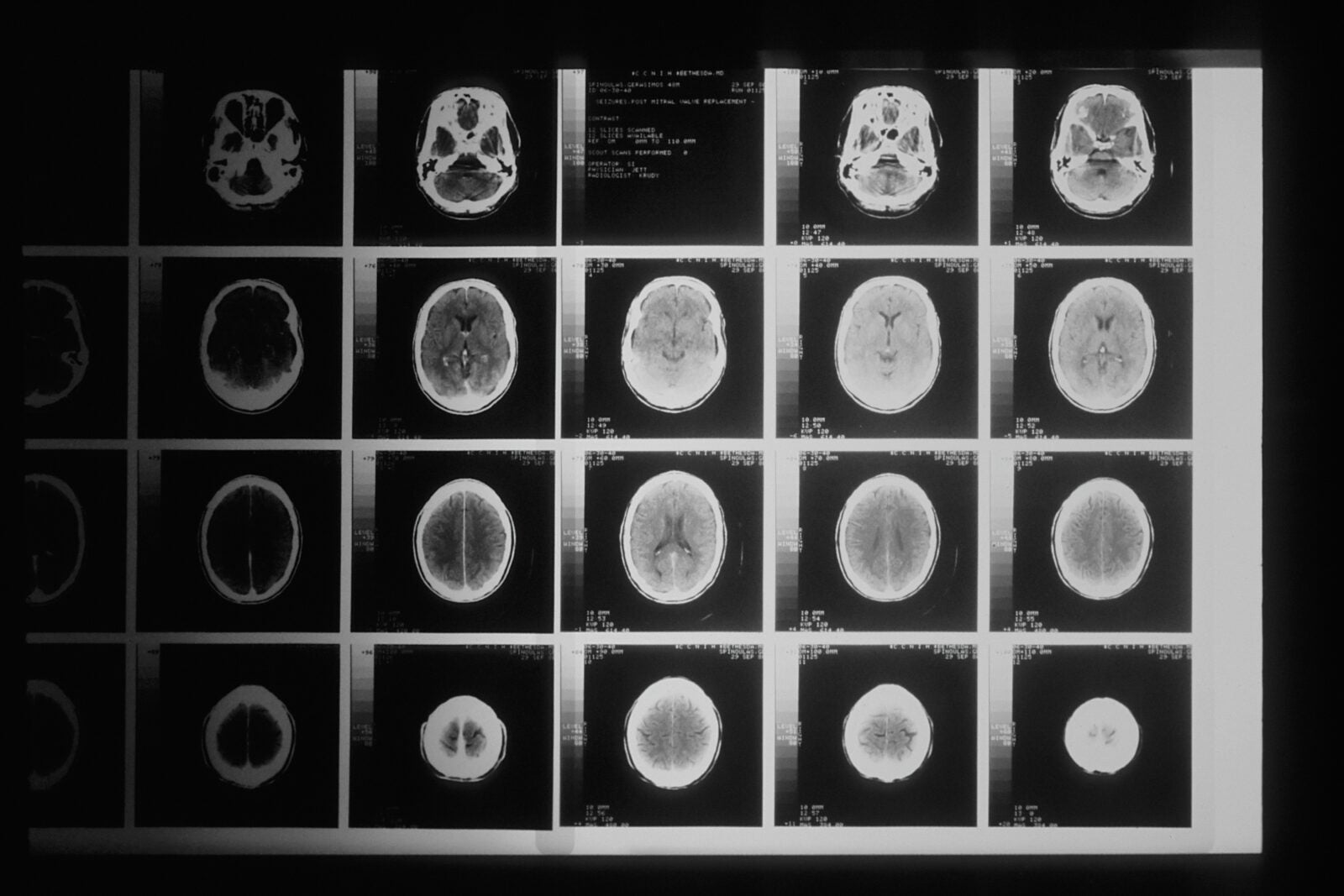 A Head X-Ray Taken By A Computer-Assisted Tomographic (Cat) Scanner. This Diagnostic Technique Uses Computers To Organize Thousands Of X-Rays, Taken By A Rotating Machine Around The Patient. When First Applied In The 1970'S It Revolutionized Detection Of Brain Tumors.