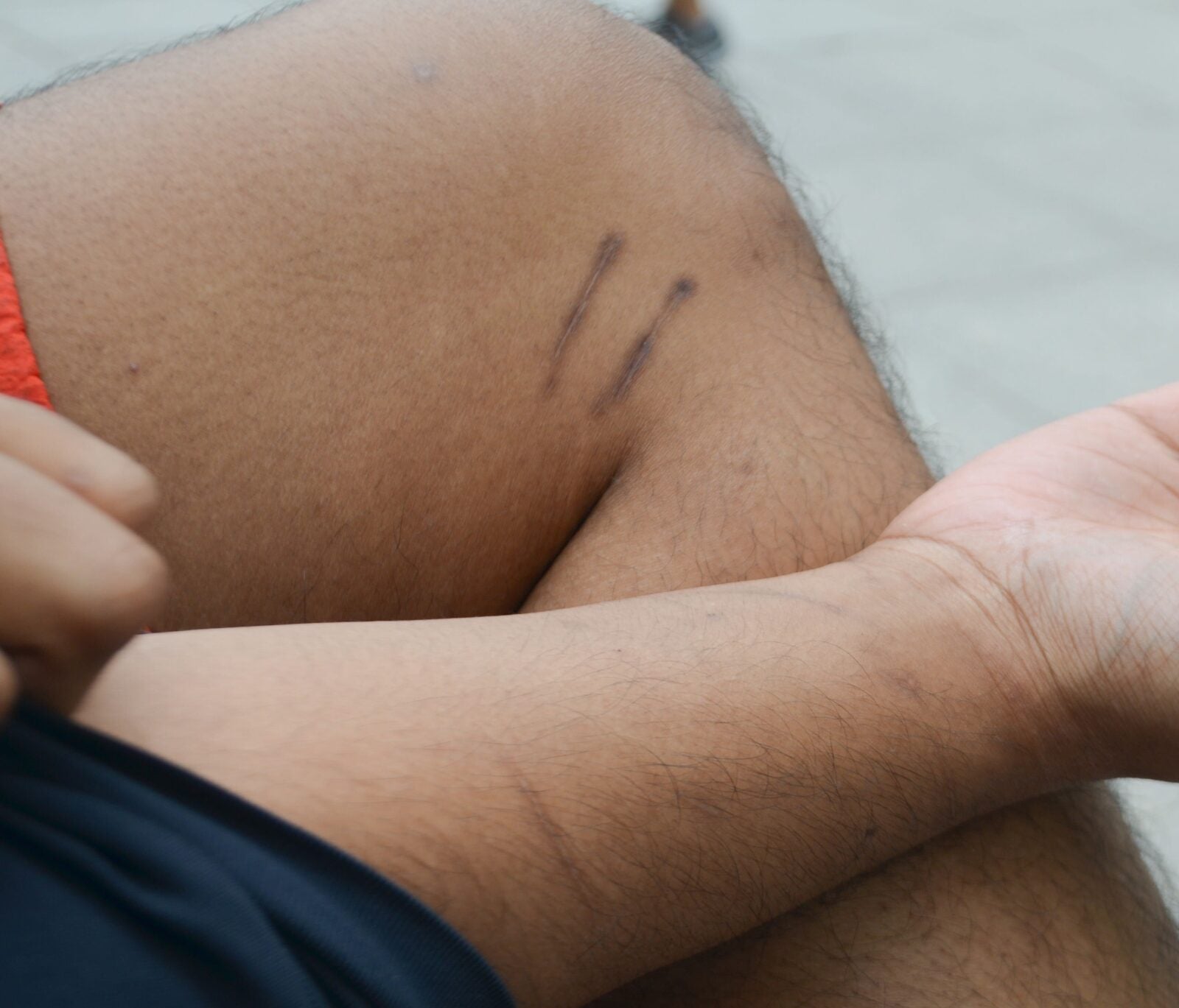 snake bite scar on a man's leg