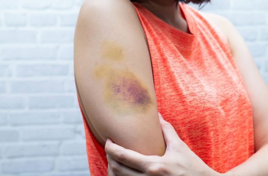 A Woman Holding Her Arm Which Is Bruised